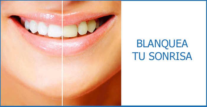 Blanqueamiento dental